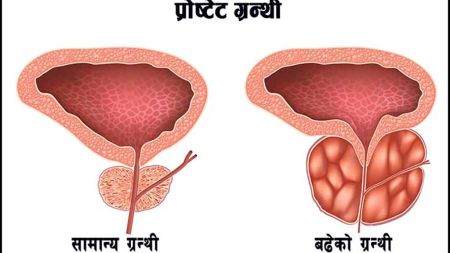 समय-समयमा प्रोष्टेट परीक्षण गर्न विज्ञको सुझाव