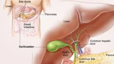 कसरी जोगिने पित्तथैलीको पत्थरीबाट? जान्नुहोस् उपाय
